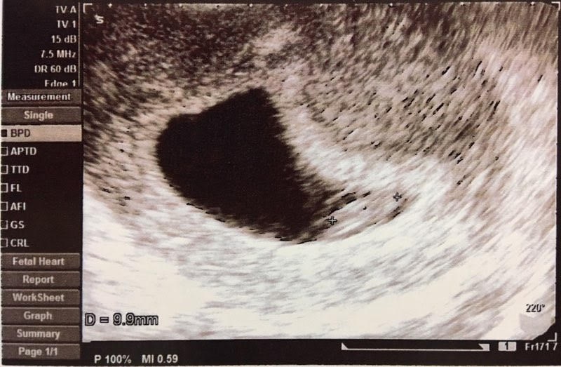 妊娠7週 3 6日 のエコー写真 体験談