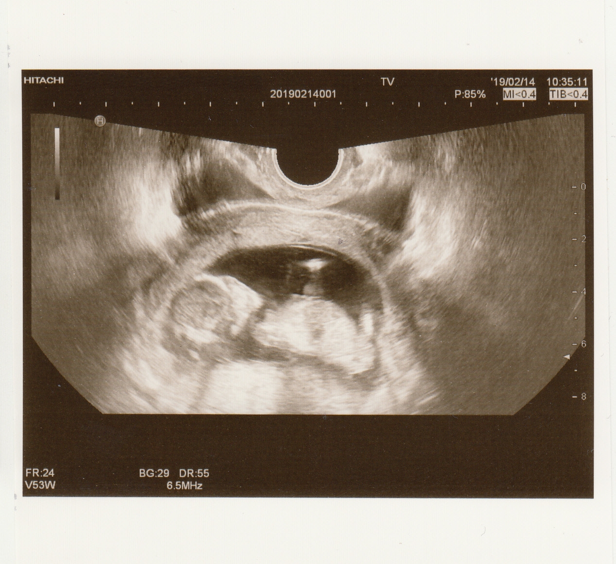 妊娠13週 3 6日 のエコー写真 体験談