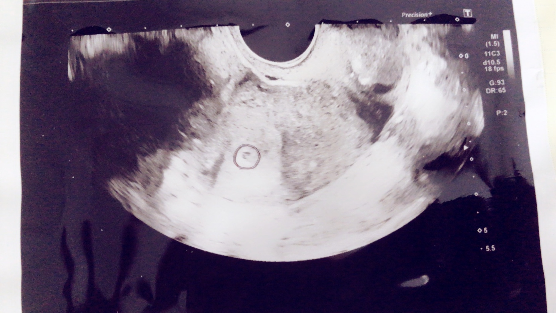 胎嚢 見え 週 ない 5 ５週0日胎嚢が見えないことについて。