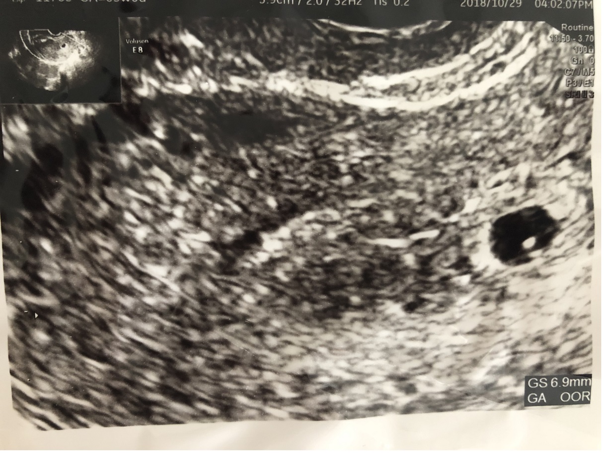 胎嚢 見え 週 ない 5 5週4日で胎嚢が見えないなんて・・・｜妊娠前期（～4ヶ月）｜妊娠・出産・育児に関する総合情報サイト【ベビカム】