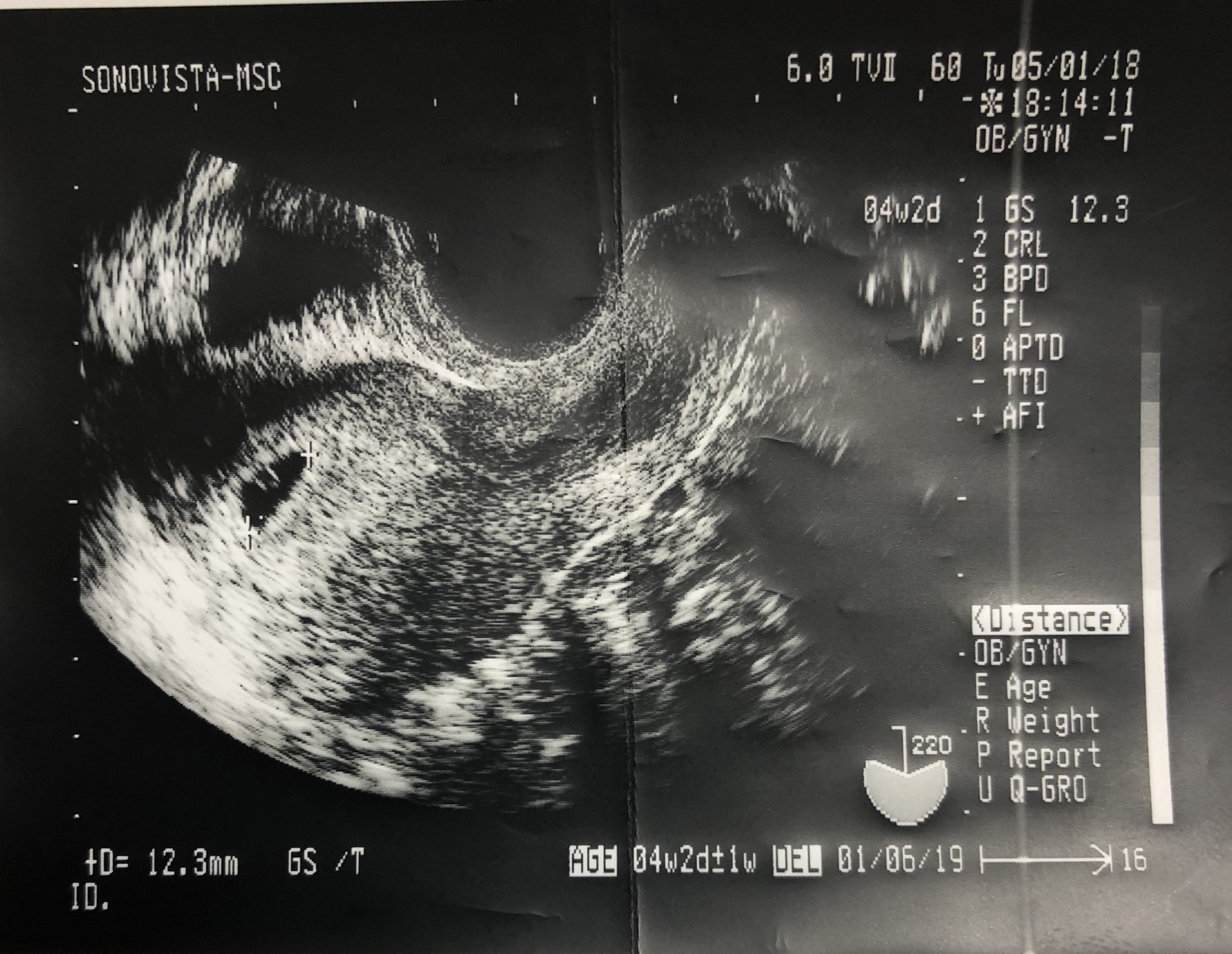 妊娠5週 3 6日 のエコー写真 体験談