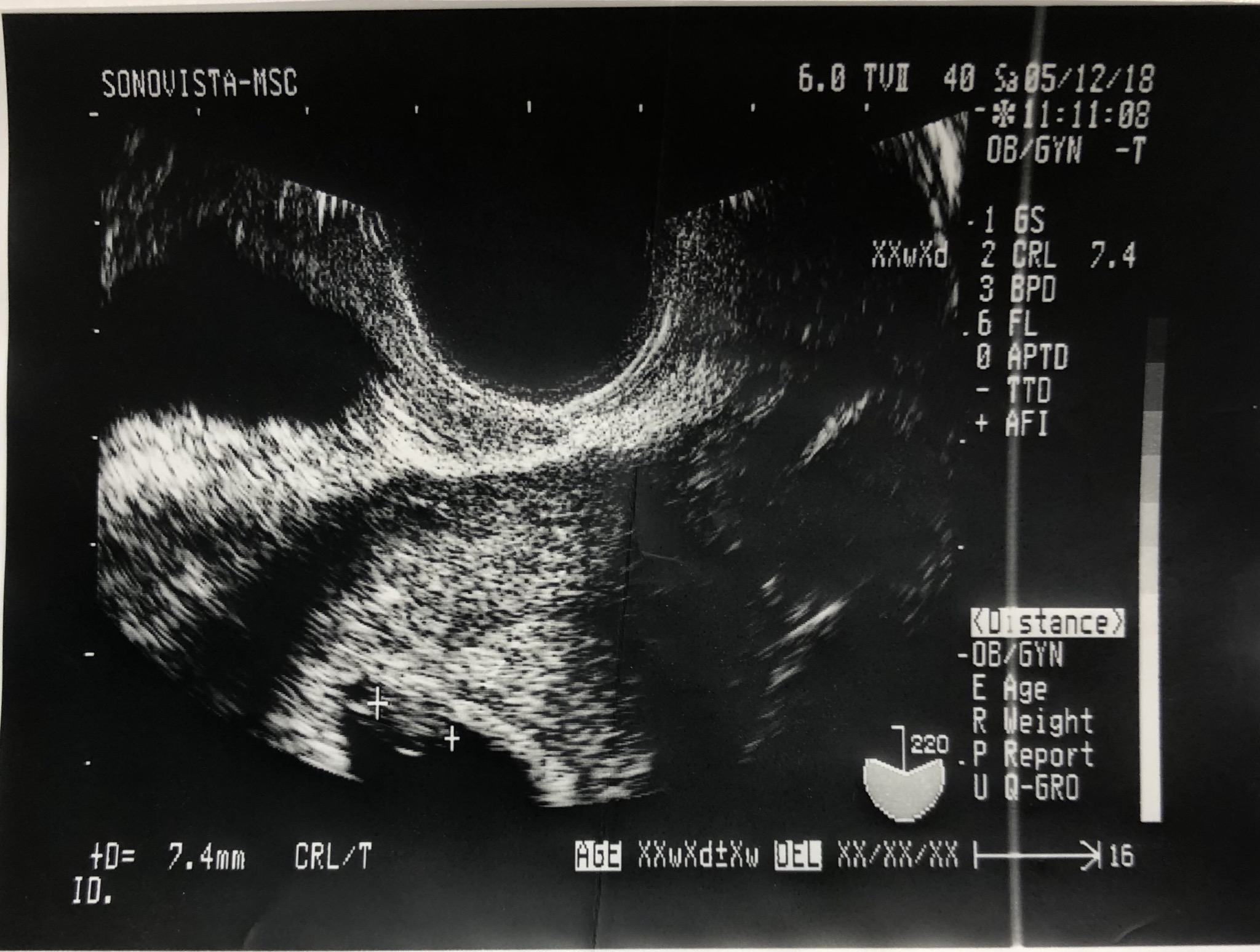 妊娠7週（0-2日）のエコー写真＆体験談