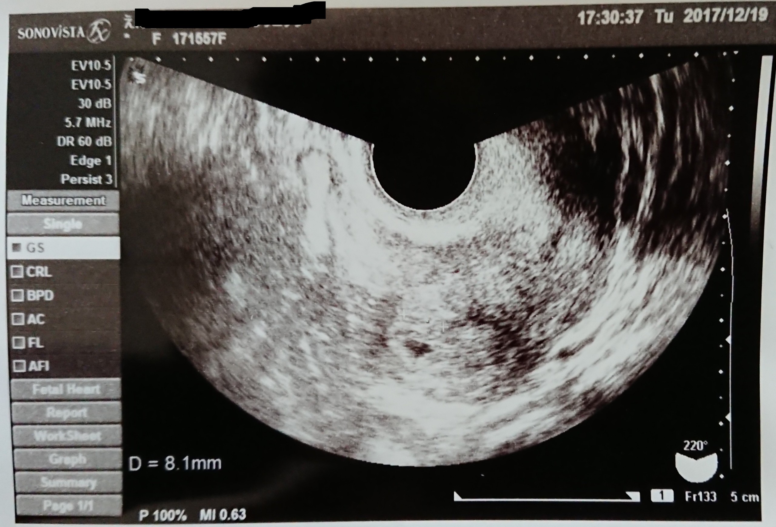 妊娠 5 週 胎嚢 大き さ