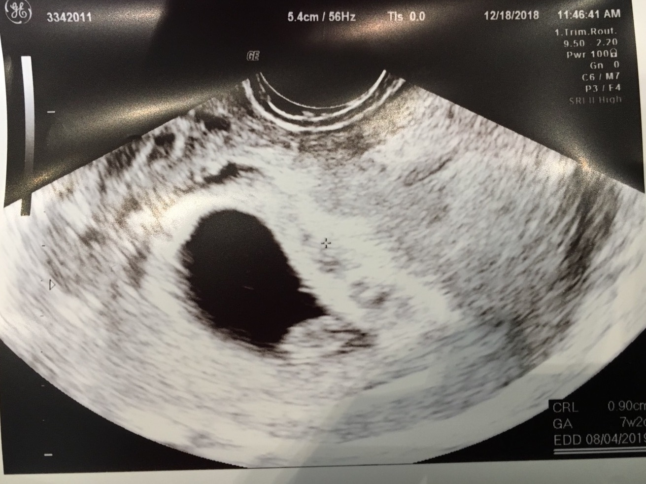 妊娠7週 0 2日 のエコー写真 体験談