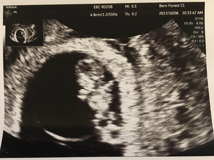 妊娠9週 0 2日 のエコー写真 体験談
