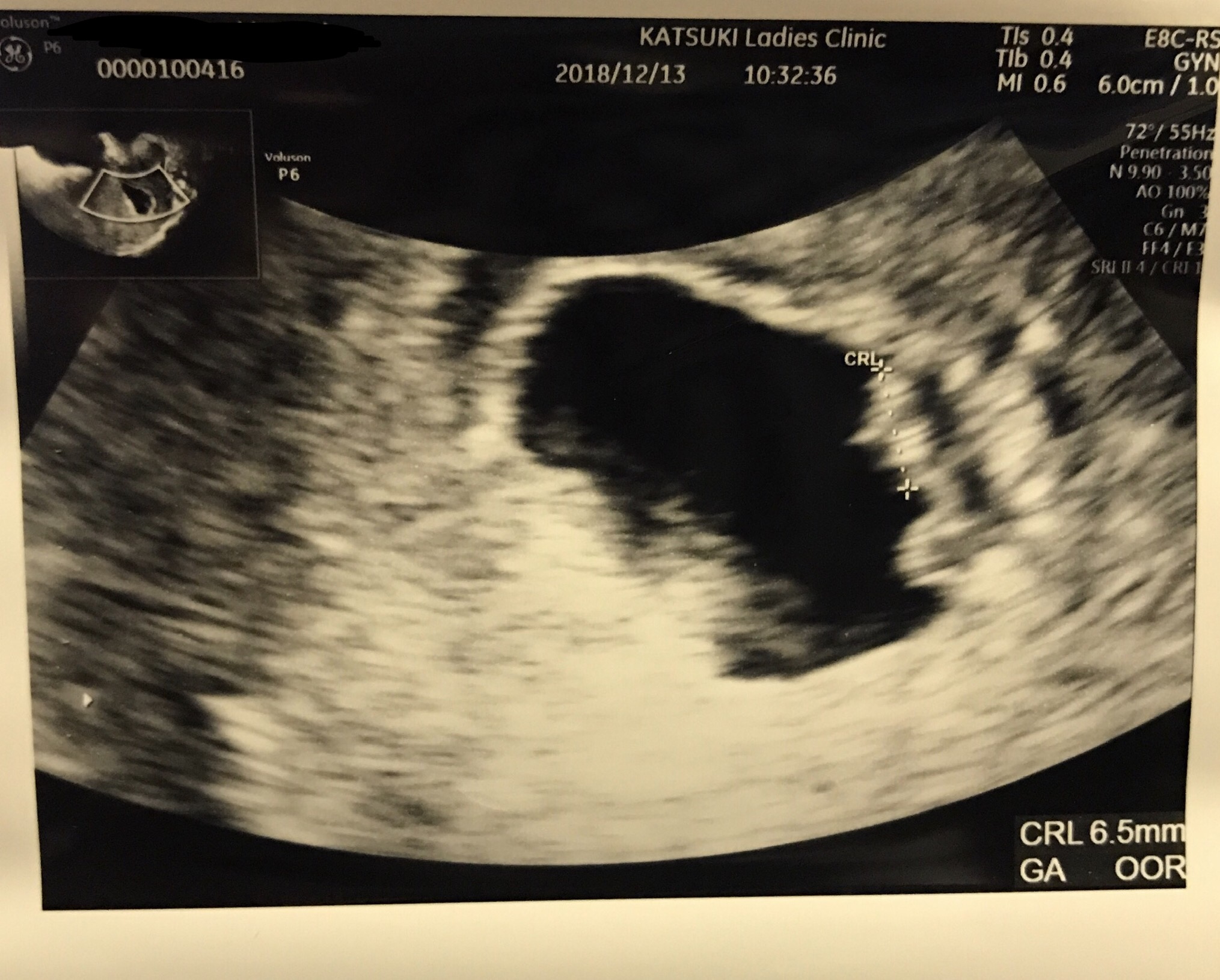 妊娠7週（0-2日）のエコー写真＆体験談