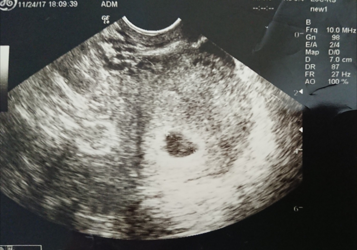 妊娠 5 週 胎嚢 大き さ