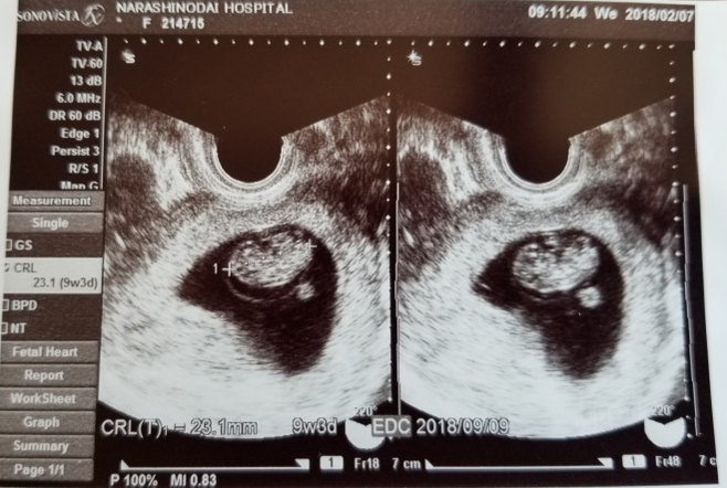 妊娠9週（0-2日）のエコー写真＆体験談